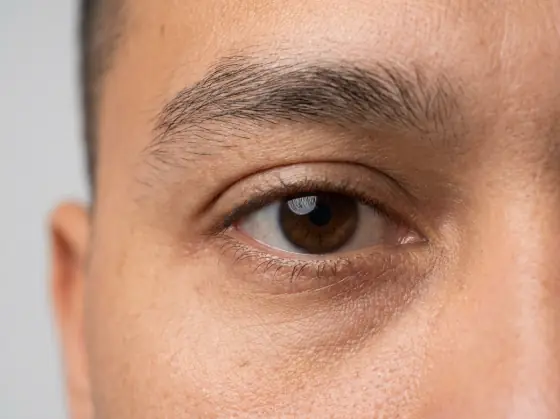 Almond eye shape: slight upward tilt, moderate opening, lid visible