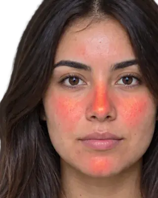 Redness heatmap from the SkinPal app