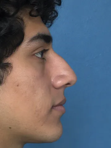 Example side profile photo with the five points numbered: brow, nose tip, under the nose, lips, chin